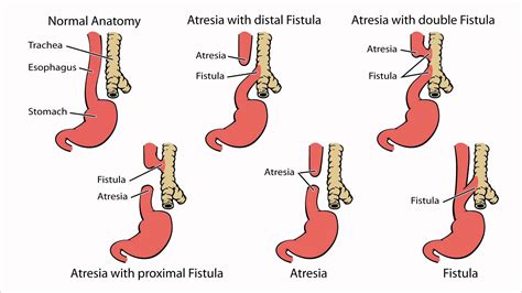 Tracheoesophageal Atresia Nursing Care Management: Study Guide - Nurseslabs