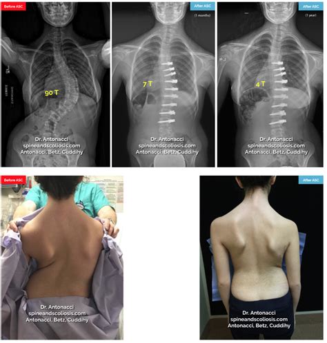 Before and After Scoliosis Surgery with Darryl Antonacci