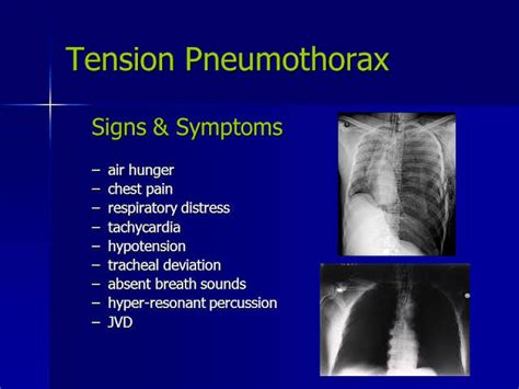 Tension pneumothorax signs & symptoms - NEET PG - www.MedicalTalk.Net ...