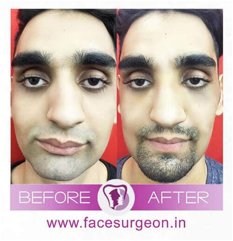 All That You Need to Know About Jaw Angle Reduction Surgery in India ...