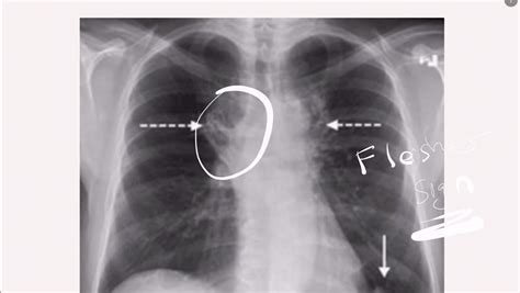 Pulmonary Embolism, Management of Pulmonary Embolism, and 2 Nursing ...