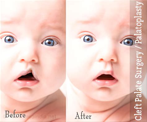 Cleft Palate Surgery | Palatoplasty - Procedure, Post-operative Care ...