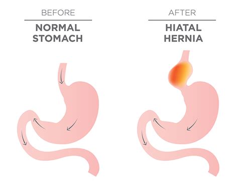 What to Know About Hiatal Hernias - University Health News