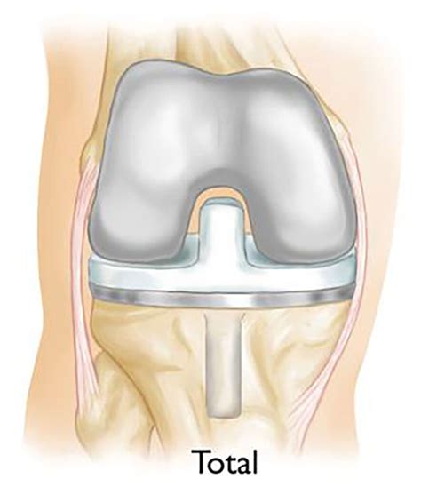 Partial Knee Replacement - Stephen J. Incavo, MD