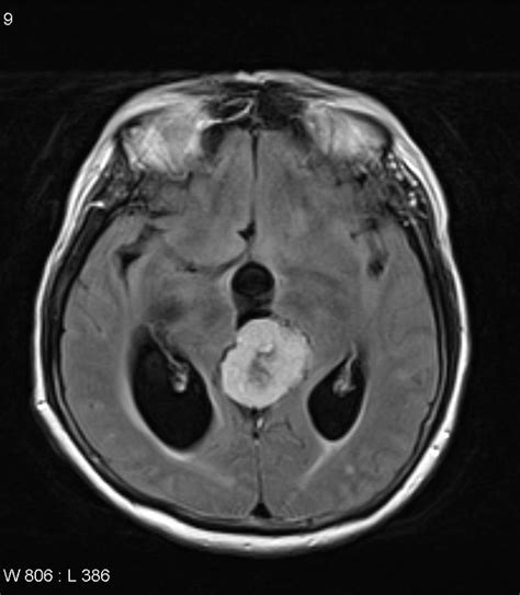 48 best Meningioma images on Pinterest