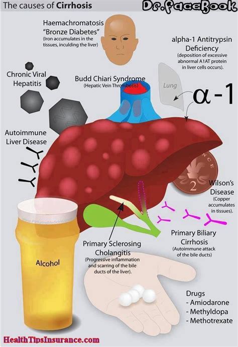 causes of cirrhosis | Causes Of Liver Cirrhosis - Health Insurance ...