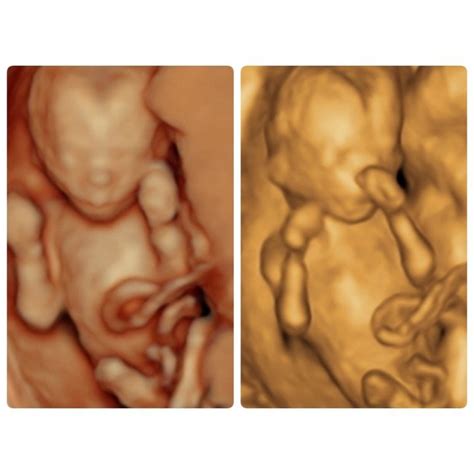 22 week 3D Ultrasound Pictures - A Date With Baby