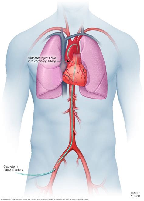 Coronary angiogram - Drugs.com