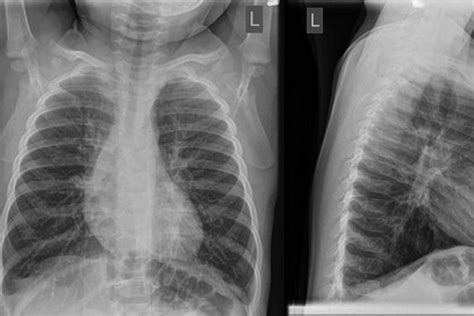 Chest X Ray Bronchitis Vs Pneumonia