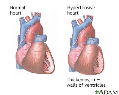 Hypertensive heart disease Information | Mount Sinai - New York