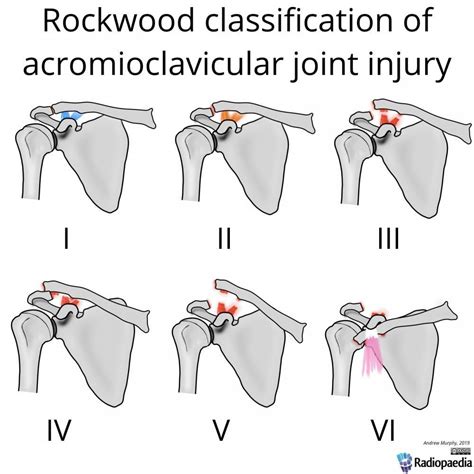 Acromio-clavicular (AC) Joint Separation: Orthopedic Center for Sports ...