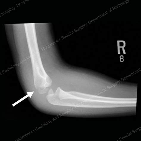 Symptoms Of Cracked Bone In Elbow - architecttione