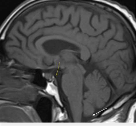 T1 sagittal MRI demonstrating capacious foramen magnum (white arrow ...