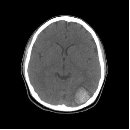 Cerebral Aneurysm Ct