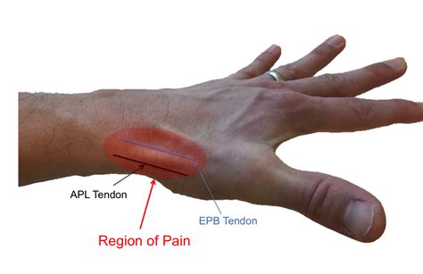 De Quervain S Tenosynovitis Surgery - slidesharetrick