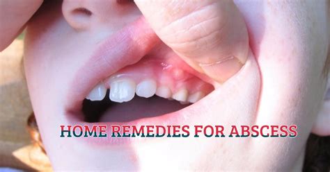 Home Remedies For Abscess - My Life With No Drugs