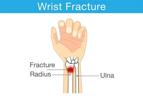 Signs Of Bone Fracture