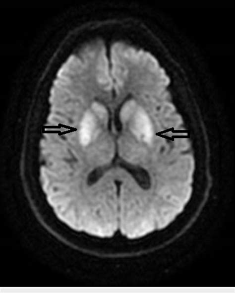 MRI brain axial DWI showing restricted diffusion in bilateral basal ...