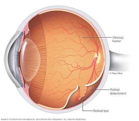 Retinal detachment - Symptoms and causes - Mayo Clinic