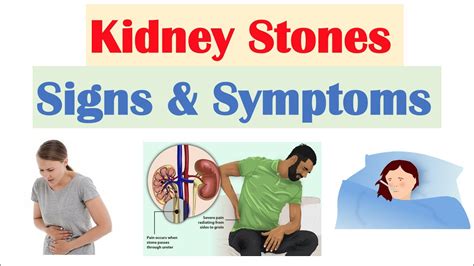 What Will Aggravate Kidney Stones? Trust The Answer - Ecurrencythailand.com