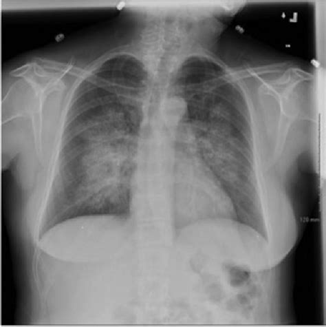 Chest plain film x-ray during admission in 2014 revealed extensive ...