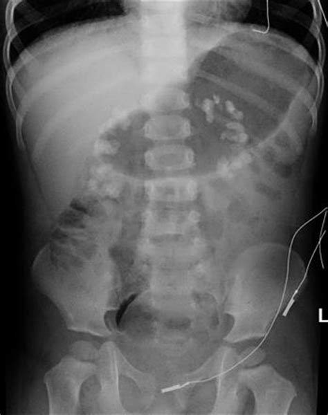 Medullary nephrocalcinosis | Radiology Reference Article | Radiopaedia.org