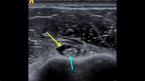 Tendon and Ligament Ultrasound - Internet Book Of MSK Ultrasound