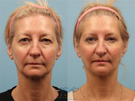 Brow Lift Before & After Photo Gallery | Vancouver, BC | YES Medspa ...