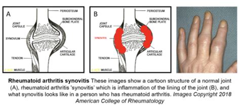 What is Synovitis? | Rheumatoid Arthritis Coach