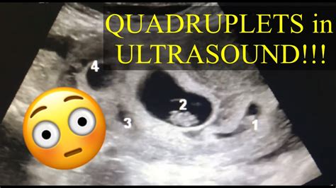 QUADRUPLETS ULTRASOUND | LOU YZA - YouTube