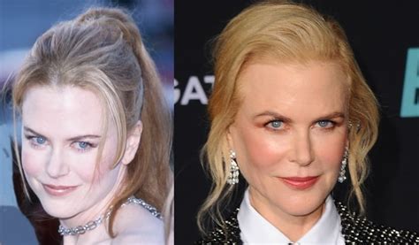 Nicole Kidman Before And After