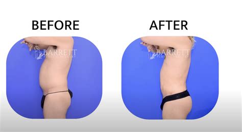 What is Recovery Like After Male Brazilian Butt Lift? 🍑 - Brazilian ...