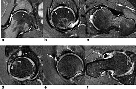 Osteoarthritis Hip Mri