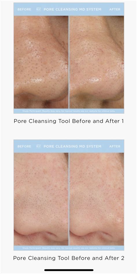 Our new Pore cleansing Tool!! | Pore cleansing, Rodan and fields, Rodan ...