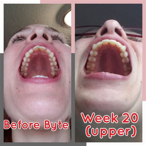 Byte Customer Reviews (Before & After Byte Treatment) | Smile Prep