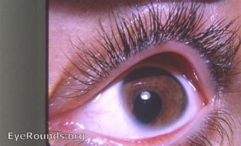 PREVENIR LA CEGUERA: COLOBOMA UVEAL: INVESTIGACION, ESTUDIOS...