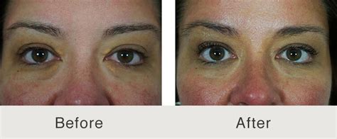 Surgery Xanthelasma Before And After - Goddess Healthy