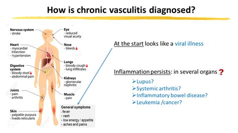 Vasculitis - Cassie and Friends Society