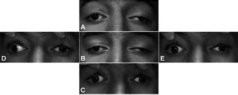 Ocular motility. Ocular motility montage of Patient 8 with no ...