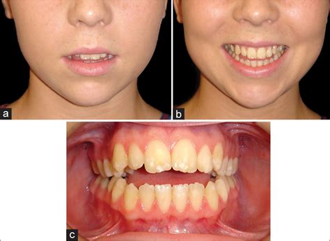 Principles of Orthognathic Surgical Correction of Skeletal Anterior ...