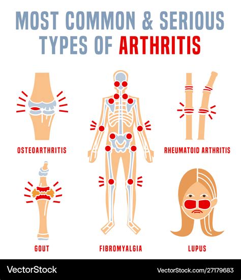 Arthritis Types Infographic Royalty Free Vector Image | The Best Porn ...