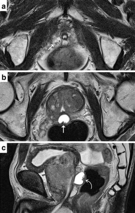 Prostate MR images. Axial T2-weighted images (a, b) showed two cystic ...