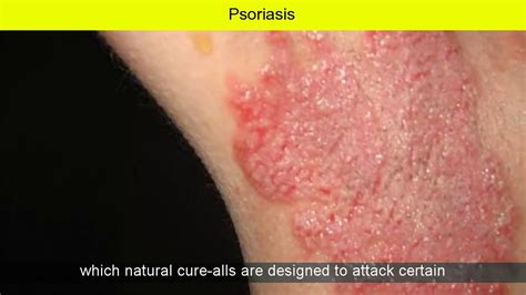 Psoriasis Ear Cure - YouTube