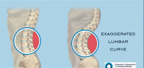 Lumbar Lordosis: What is it, symptoms, treatments, and causes ...