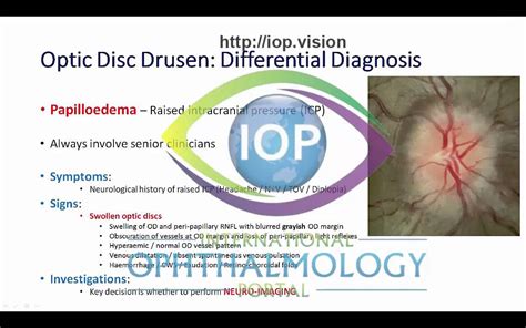 Optic Disc Drusen Part 2 Preview - YouTube