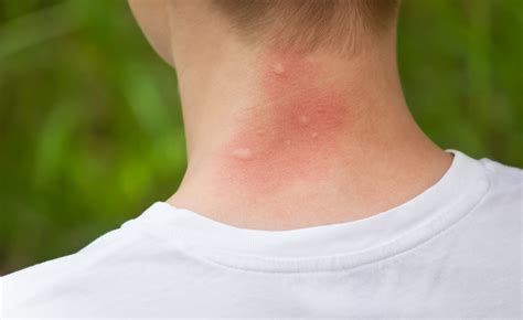 What Do Dust Mite Bites Look Like? Check Signs And Symptoms Here