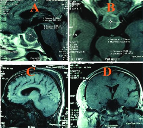 (A and B) shows Pre-operative Contrast enhanced T1 Sagittal and T1 ...