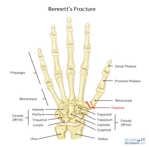 Bennett's Fracture | Rehab My Patient