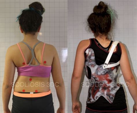 Scoliosis Brace for Patients Who Don't Want Surgery | Scoliosis ...