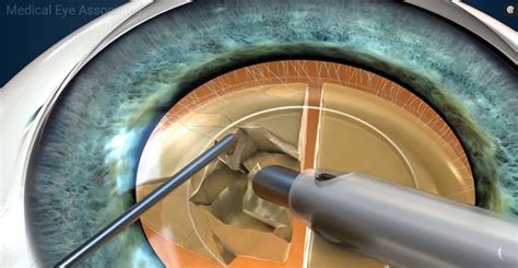 Cataract Surgery at Medical Eye Associates - Doctors Surgery Center